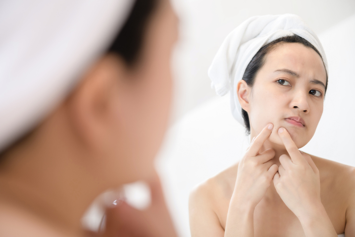 Here's Why Popping Pimples at Home Can Harm Your Skin