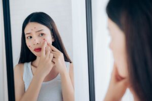 The Hidden Triggers of Adult Acne and How to Avoid Them